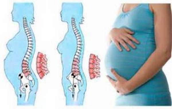 Защемление седалищного нерва во время беременности